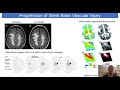 A Novel Blood-Based Biomarker for Silent Cerebral Edema and Brain Vascular Injury