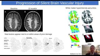 A Novel Blood-Based Biomarker for Silent Cerebral Edema and Brain Vascular Injury