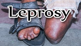 Leprosy Documentary - DSWC Dhanbad - Nirmala leprosy Hospital Govindpur