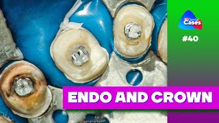 ENDO and crown | BG Dental Cases #40 @Belogradacademy