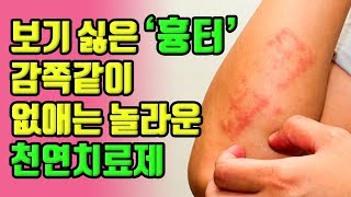 보기싫은 '흉터' 감쪽같이 사라지게 만드는 놀라운 천연 치료제