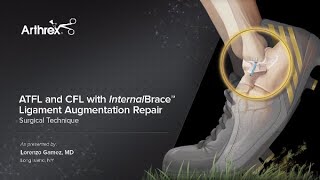 ATFL and CFL with InternalBrace™ Ligament Augmentation Repair
