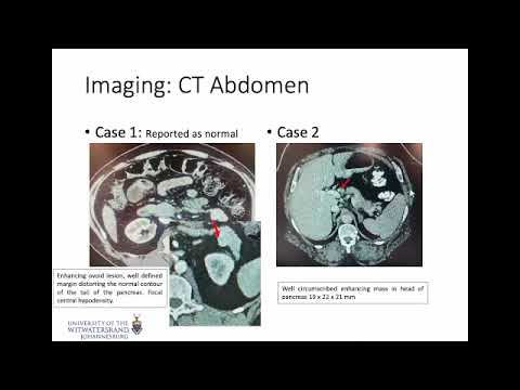 Insulinoma - From Diagnosis To Treatment - YouTube