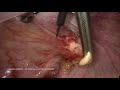 pararectal endometriosis nodule laparoscopic excision with the monopolar needle