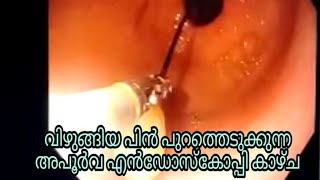 വിഴുങ്ങിയ പിൻ പുറത്തെടുക്കുന്ന അപൂർവ കാഴ്ച | Endoscopy