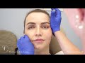 sculptra the liquid facelift pearlman aesthetic surgery