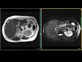 T2 Turbo Spin Echo Sequence on MRI - Liver Protocols