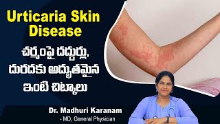 చర్మంపై దద్దుర్లు, దురద వస్తే.! | Understanding Urticaria Skin Disease In Telugu | Sankhya Hospitals