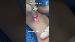 손목 사자자리 문신(타투)제거 ASMR - ALL 수면마취 [Laser Tattoo Removal]