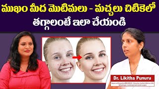 మొటిమలతో ఇబ్బంది పడుతున్నారా  | How to Rid of Pimples Fast | Pimple Problem Solution | Skin Care