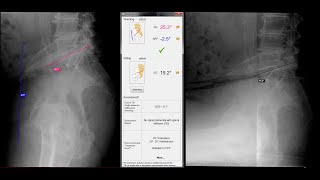 Spinopelvic Assessment Software for Total Hip Arthroplasty