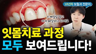 잇몸치료 미리 하시고 잇몸수술 피하세요!! 치료방법 총정리