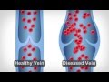 Varicose Vein Treatment with the Venefit™ Procedure