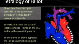 14 Cardiac  05 Congenital Heart Disease PATHOLOGY