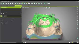 DWOS  - Create an upper partial and add rod for casting