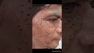 DPN - DERMATOSIS PAPULOSA NIGRA \u0026 ITS REMOVAL VIA ELECTROCAUTERY