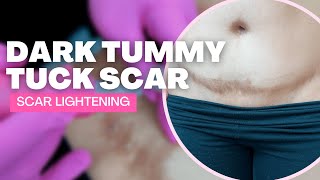 Scar Lightening for a Tummy Tuck Scar