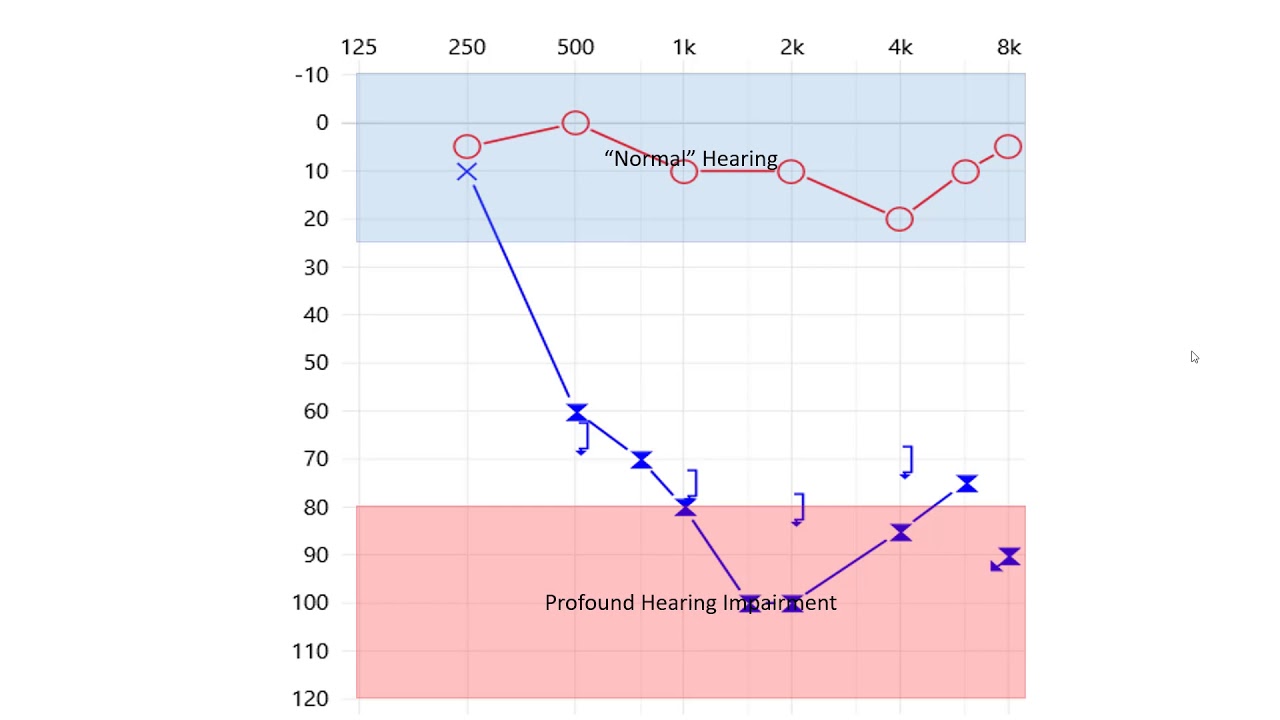Explaining The Audiogram Youtube