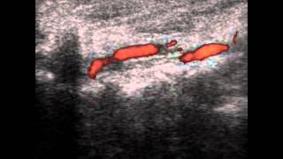 VERTEBRAL ARTERY DISSECTION