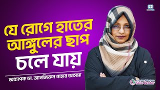 যে রোগে হাতের আঙ্গুলের ছাপ চলে যায় #Adermatoglyphia