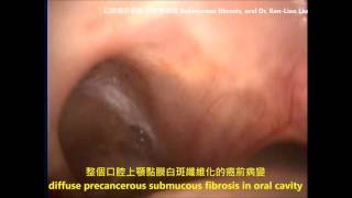 口腔癌前病變 白斑 黏膜下纖維化 檳榔引起 betelnut diffuse oral submucous fibrosis precancer lesion