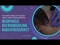 TIGHTEN AND LIFT YOUR NECK AND JAWLINE WITH MORPHEUS MICRONEEDLING RADIOFREQUENCY | JASON EMER, MD