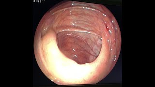 Colonoscopy: importance of good cecum inspection