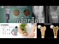 osteoporosis ជំងឺពុកឆ្អឹង your health.mp3