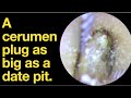 A cerumen plug as big as a date pit.|ear wax removal | ear cleaning | ASMR | relaxation | relax