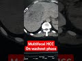 Multifocal hepatocellular carcinoma on CT triphasic scan||HCC on washout phase