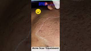 Dr. Rohit Goel Acne scar Reduction