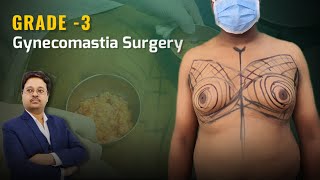 Grade 3 Gynecomastia surgery | Male breast Reduction | ছেলেদের বড় স্তন ছোট করার সার্জারি | Dr. bain