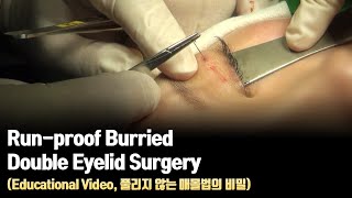 Run-proof Burried Double Eyelid Surgery (Educational Video, 풀리지 않는 매몰법의 비밀)