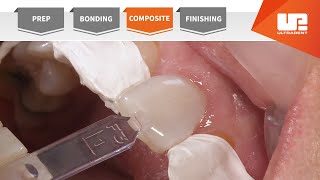 Composite | Your Complete Restorative Solution