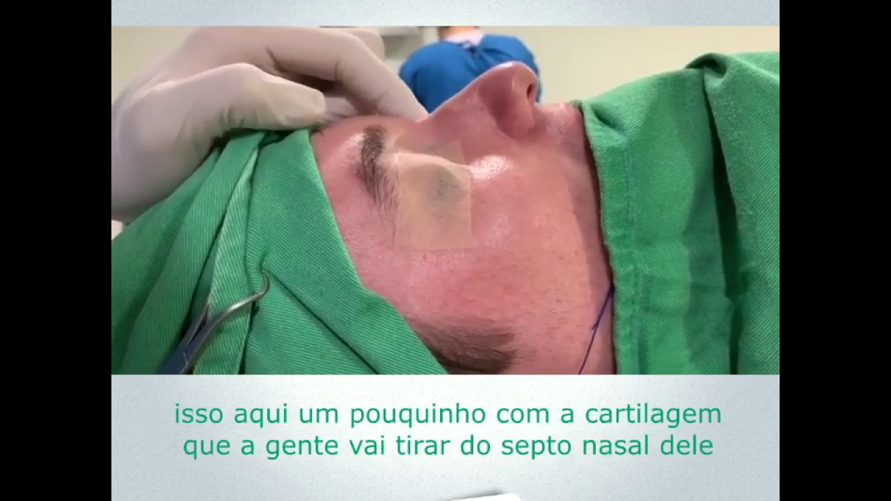 Rinoplastia Perfeita [ANTES E DEPOIS - Cirurgia] - YouTube