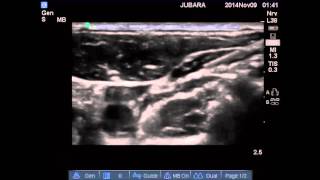 INTERMEDIATE CERVICAL +SUPERFICIAL CERVICAL PLEXUS BLOCK