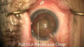 How to Quick Chop and Vertical Chop Cataracts. Chris Teng, MD