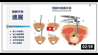 創新「雙通道脊椎微創內視鏡手術」技術在脊椎手術的應用與發展 l 亞東紀念醫院