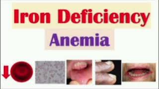 IDA_ Iron deficiency anemia #mrcpch Communication