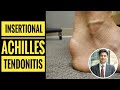 Insertional Achilles Tendinitis (How to Diagnose?)