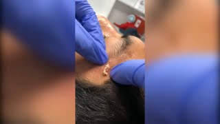 Popping huge blackheads and Giant Pimples - Best Pimple Popping Videos #125