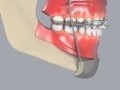 Class III Reverse Pull Headgear Appliance