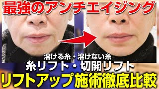 切開リフトと糸リフト、どちらの方がアンチエイジング効果がある？日本一の小顔整形医がリフトアップ施術を徹底解説！