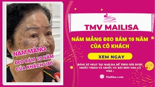 Thẩm Mỹ Viện Mailisa Tư Vấn Loại Bỏ Nám Mảng Chị Em Không Nên Bỏ Qua Video Này