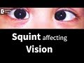 Can squint affects vision later in life? - Dr. Sunita Rana Agarwal