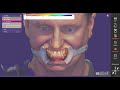 Integrating Metismile Facial Scans with Exocad and Blue Sky Plan