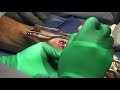 bridge plating for distal radius fractures