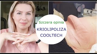 KRIOLIPOLIZA COOLTECH 🔵 BARDZO SZCZERA OPINIA 🔵 PRAWIE idealna