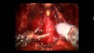 Human Amniotic Membrane for Prostate Surgery, uploaded September, 2012