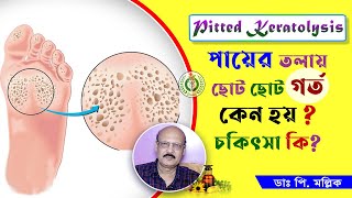 পায়ের তলায় ছোট ছোট গর্ত কেন হয়, চিকিৎসা কি? | Pitted Keratolysis Treatment | Dr Prokash Mallick